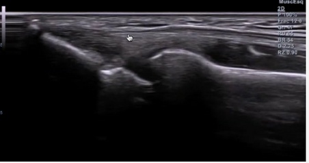 Ecografia-Epicondilo image